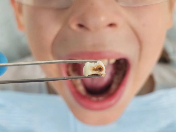 Best Emergency Dental Care for Broken or Chipped Teeth in Sullivan, MO